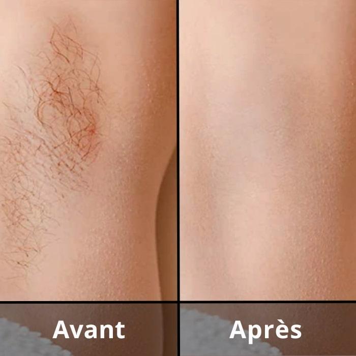 Épilateur IPL – Épilation Permanente et Sans Douleur à Domicile